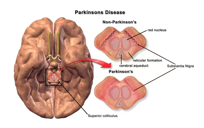 Parkinson’s Disease FAQS Part-3